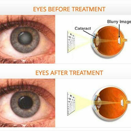 ISOTINE PLUS EYE DROPCataract Eye Drops OFFICIAL USA Organic Herbals Care Glaucoma Cataracts, FREE SHIPPING